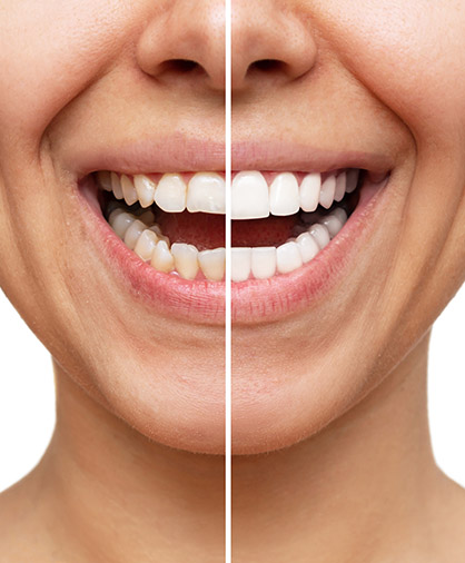 Cosmetic dentistry before & after