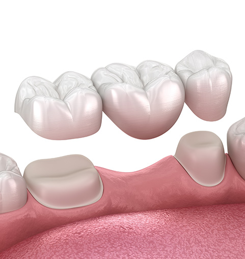 Graphic of dental bridge attachment process