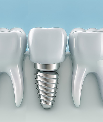 Dental implant 3D graphic