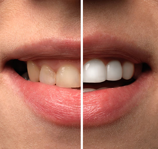 Teeth whitening before and after treatment at Oxnard Dental Office